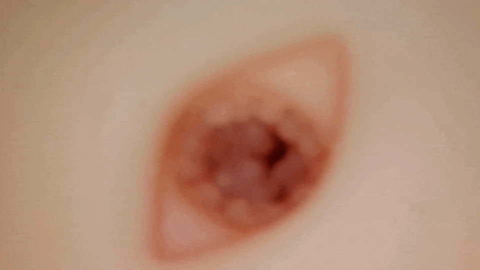 螺旋軟Q肉芽SOFT的內部攝影