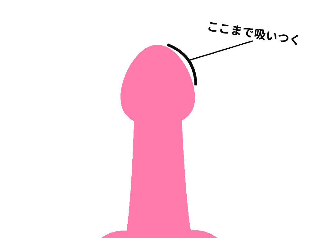 龜頭縮窄處