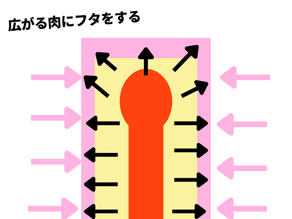 外偏軟內超軟雙層結構的優點