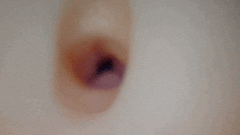 感觸標本 捻轉的內視鏡畫面
